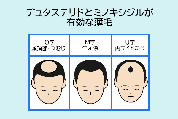 ミノキシジルとデュタステリドが有効な薄毛