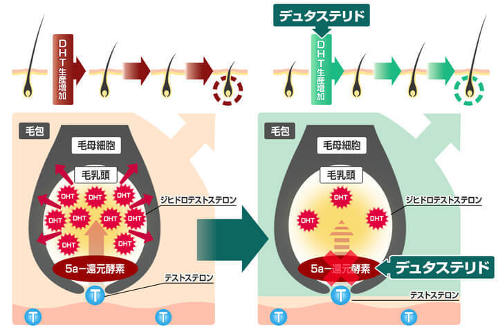 デュタストロンの作用機序