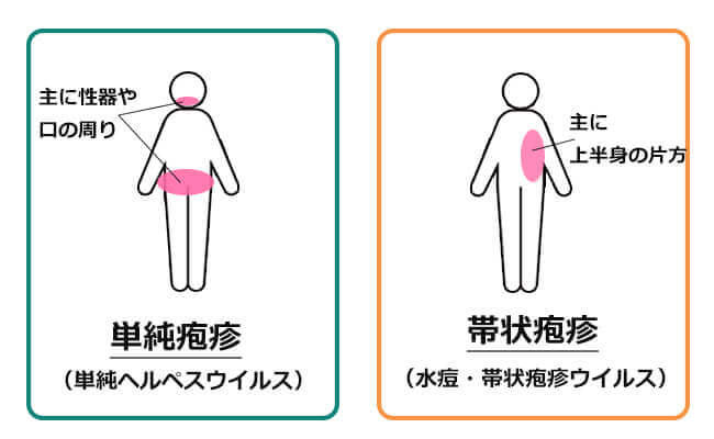 単純疱疹と帯状疱疹の違い